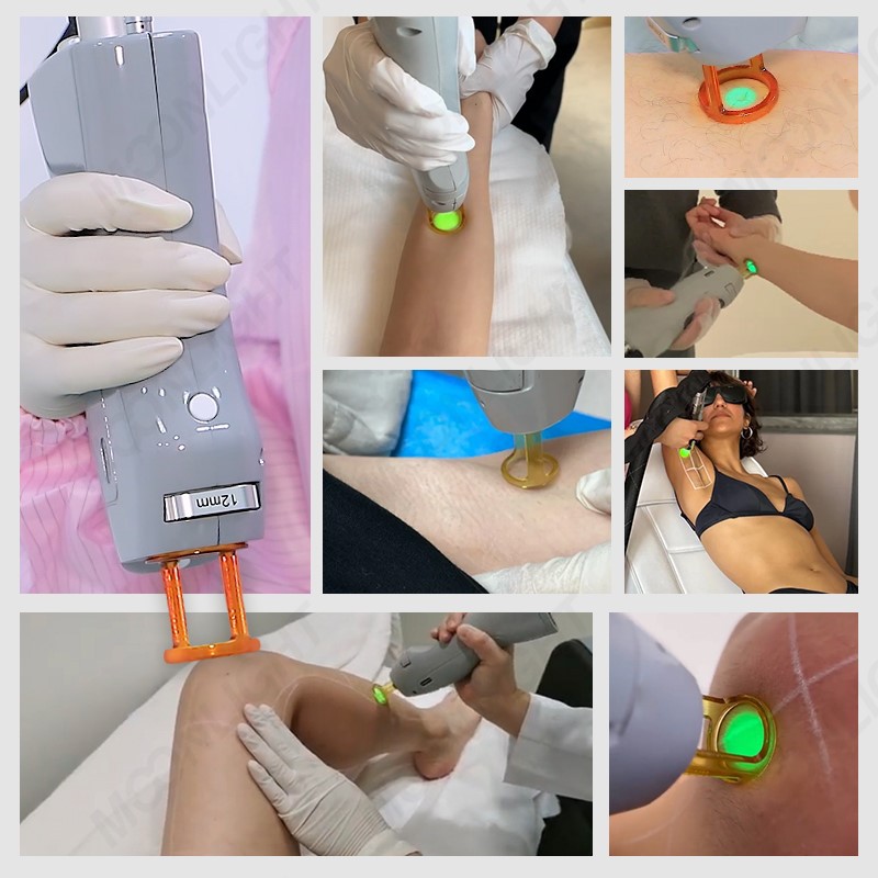 Alexandrite-laser-08 Alexandrite-laser-08