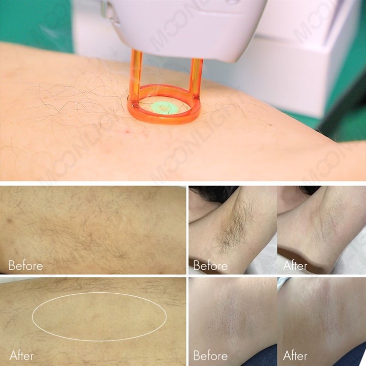 755nm Alexandrite Laser