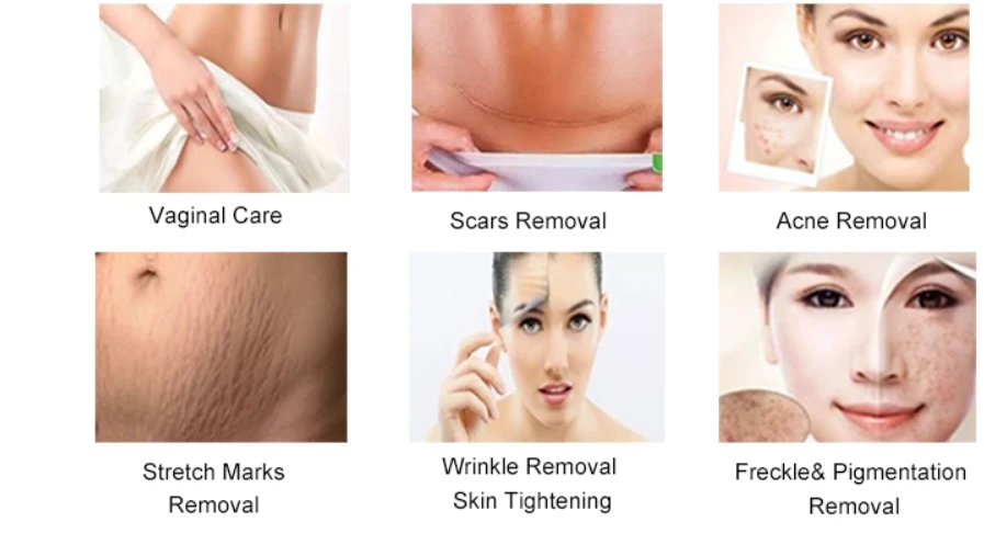 Co2 Fractional Laser Machine For Skin